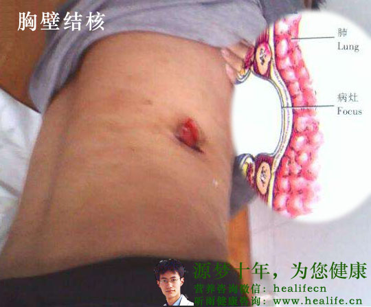 胸壁结核