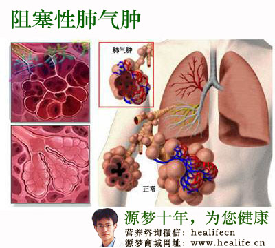 阻塞性肺气肿