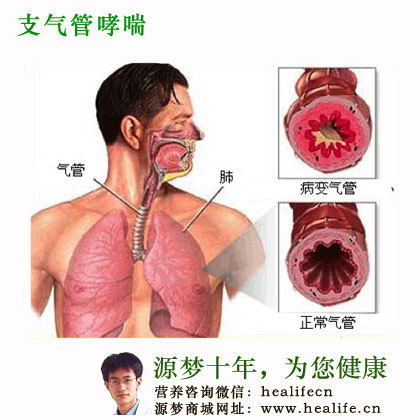 支气管哮喘
