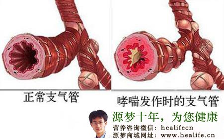 支气管哮喘