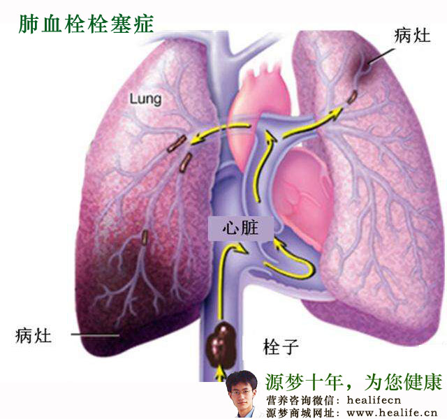 肺血栓栓塞症