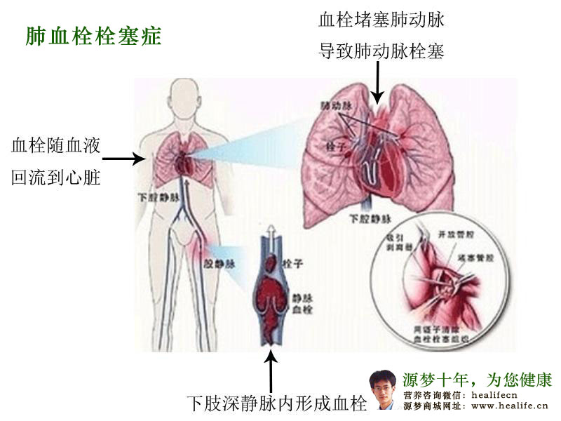 肺血栓栓塞症