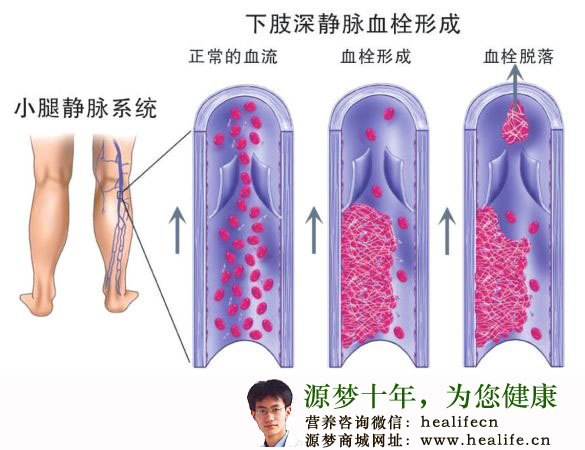 下肢深静脉血栓形成