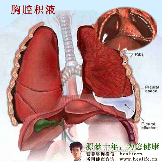 胸腔积液