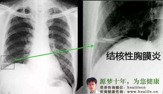 结核性胸膜炎