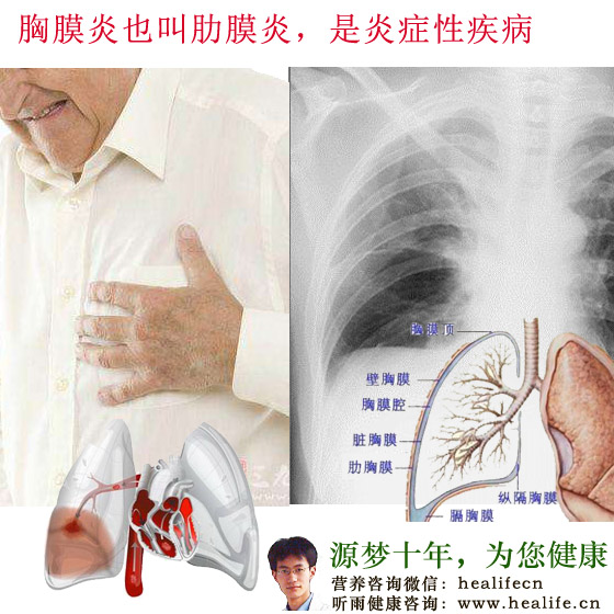 胸膜炎