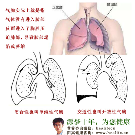 气胸