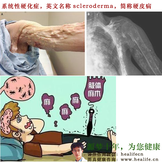 系统性硬化症,英文名称scleroderma,简称硬皮病