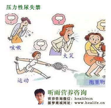 压力性尿失禁