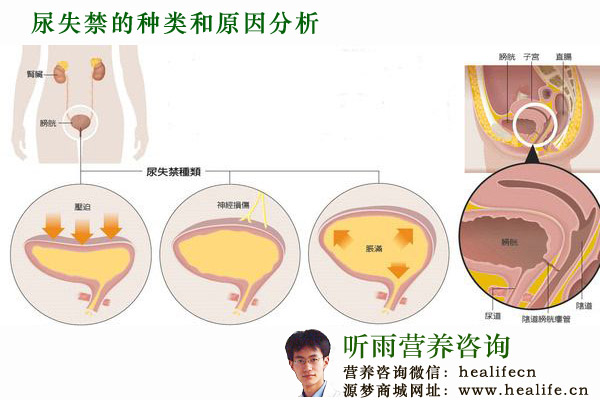尿失禁的种类和原因分析