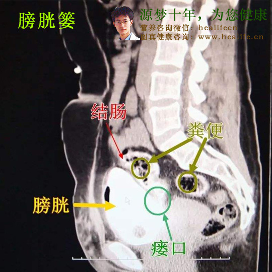 膀胱篓