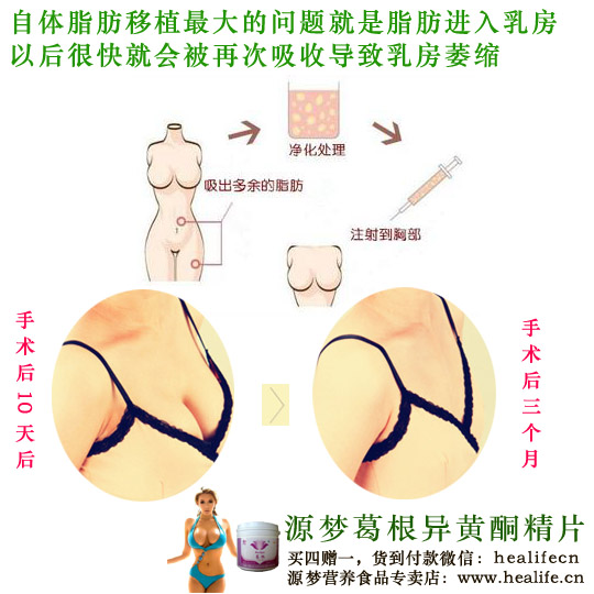 自体脂肪移植丰胸术存在巨大问题