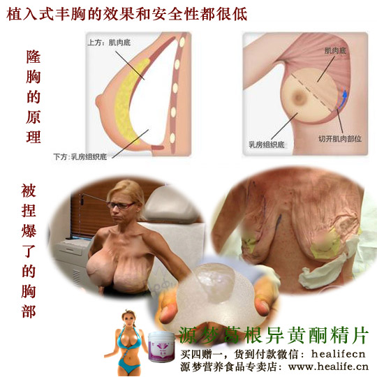 植入性丰胸的效果和安全性都很低,很容易被捏爆