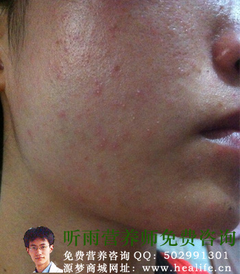 过敏症状