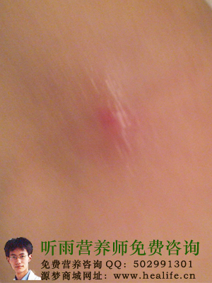 图真自身实例教你如何解决毛囊炎