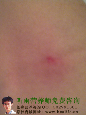 图真自身实例教你如何解决毛囊炎