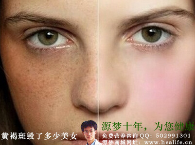 黄褐斑坏了多少美女