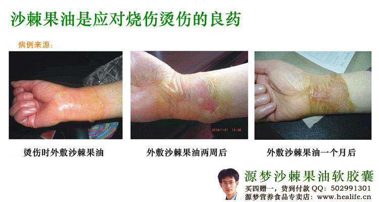 沙棘果油是应对烧伤烫伤的良药